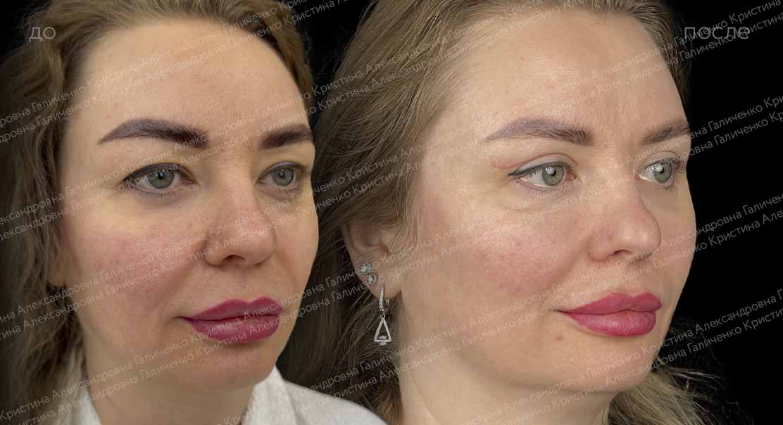 Ориентальная блефаропластика