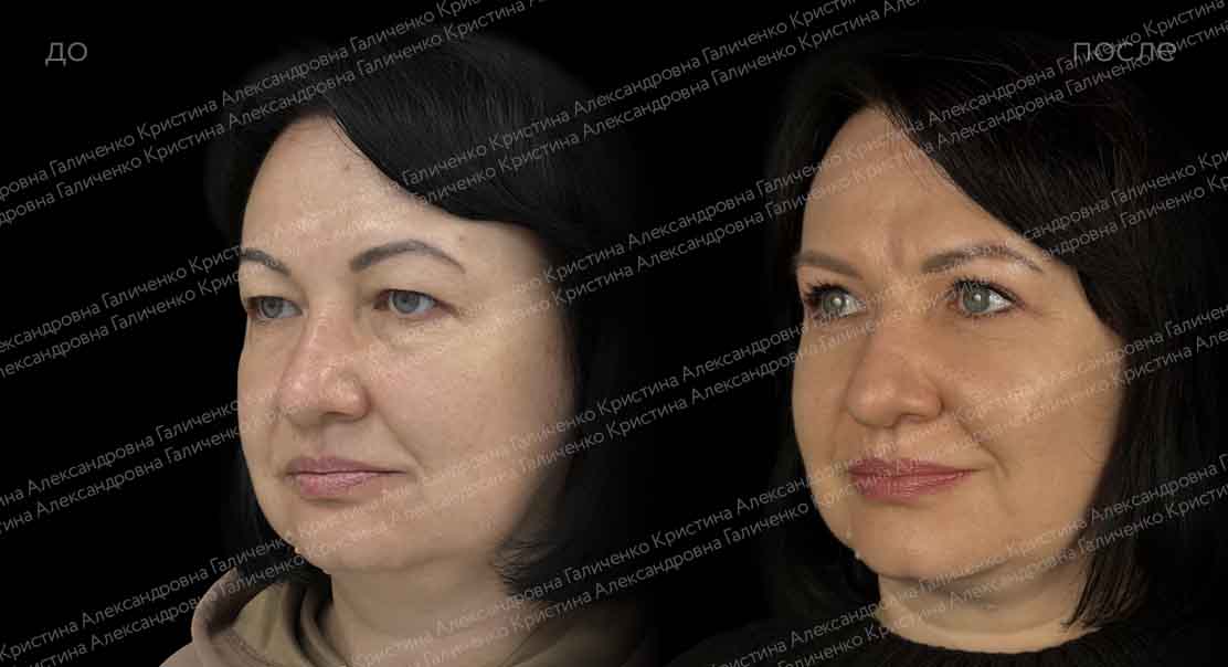 Круговая блефаропластика и миопексия