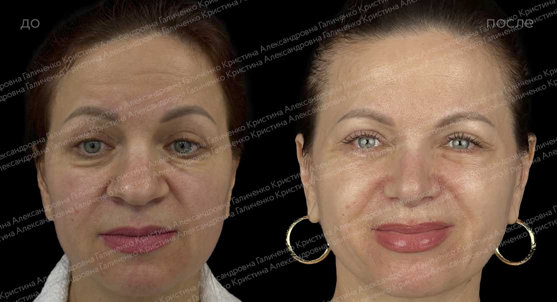 Нижняя блефаропластика с миопексией