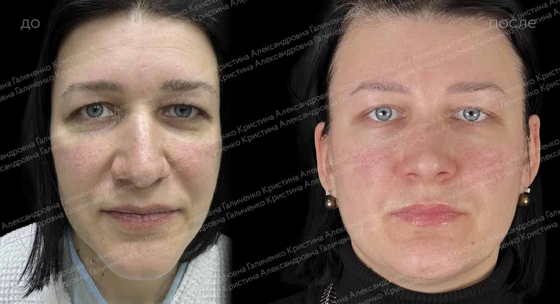Верхняя блефаропластика + подтяжка лба и висков