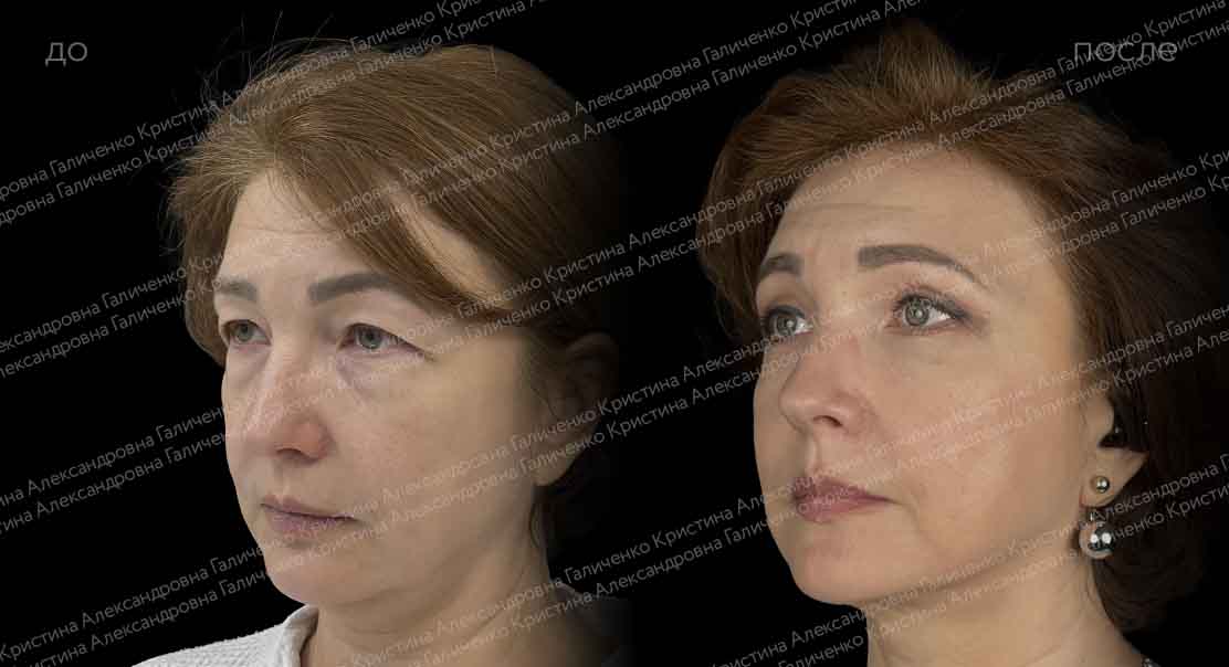Круговая блефаропластика с миопексией