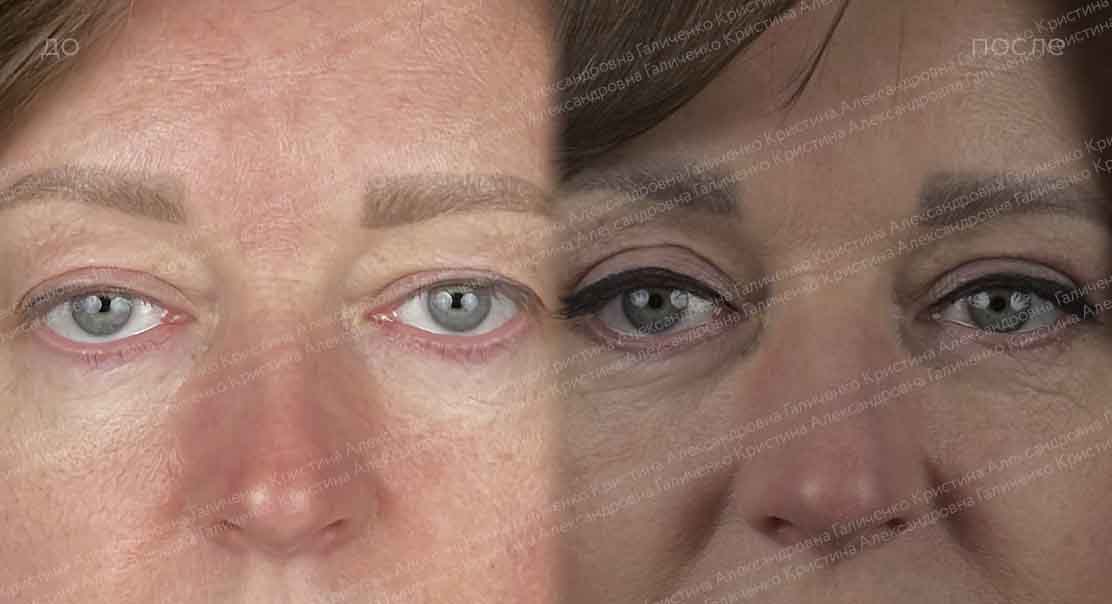 Верхняя блефаропластика