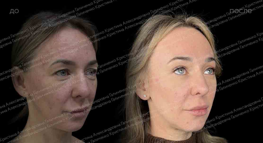 Эндоскопический лобно-височный лифтинг + верхняя блефаропластика