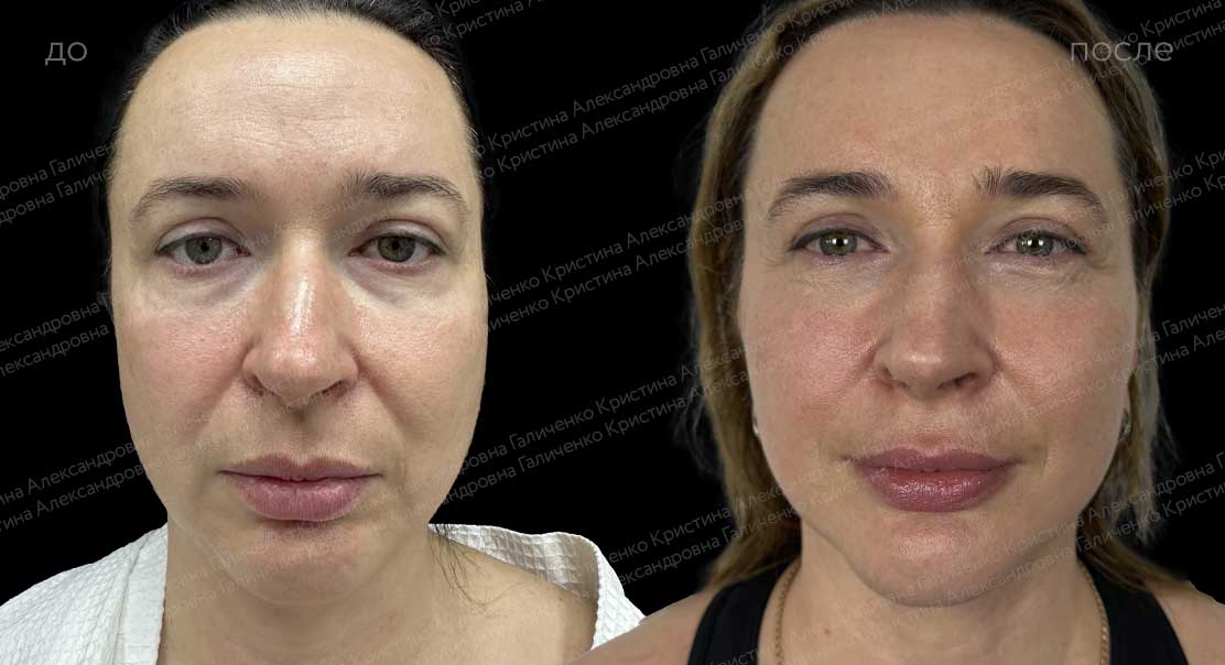 Лифтинг средней и нижней трети лица и шеи с коррекцией рубца на подбородке