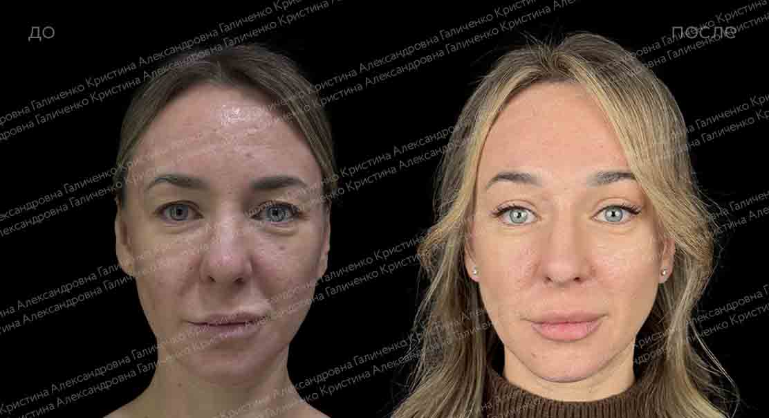Эндоскопический лобно-височный лифтинг + верхняя блефаропластика