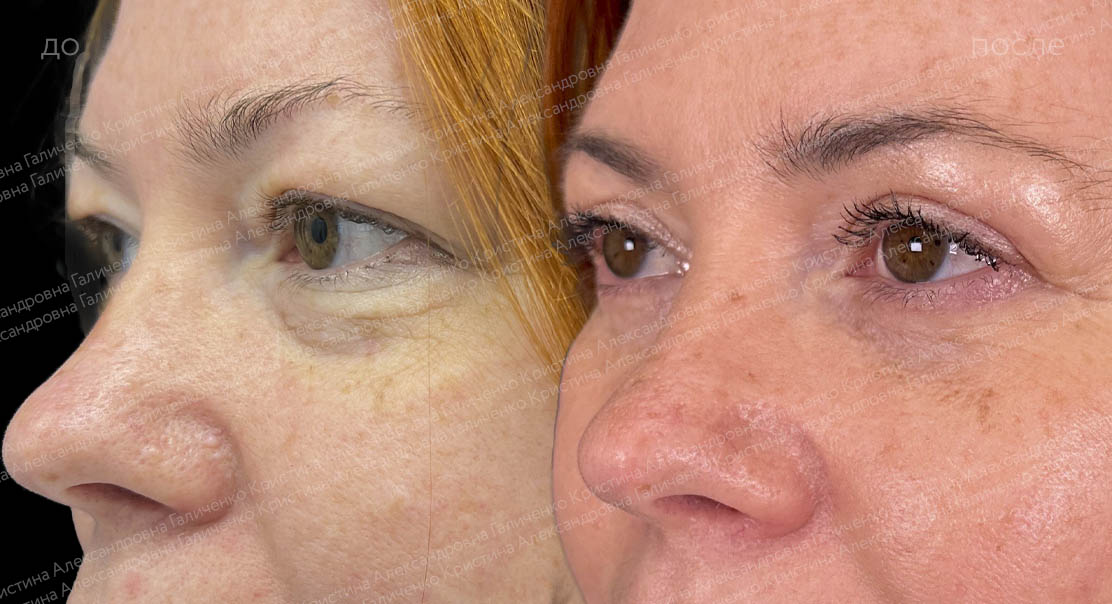 Круговая классическая блефаропластика