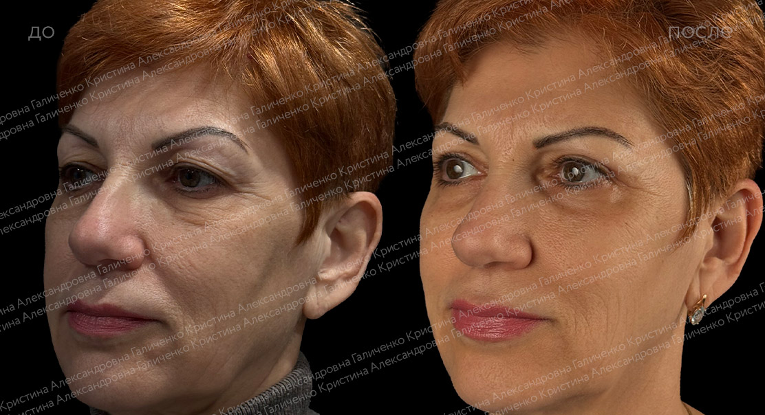 Круговая блефаропластика