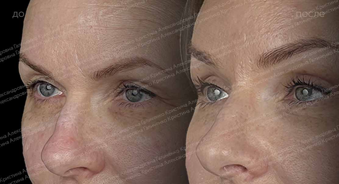 Верхняя блефаропластика + эндоскопический лобно-височный лифтинг