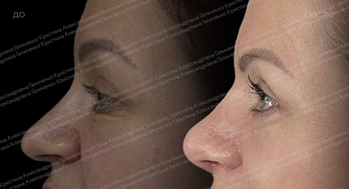 Нижняя блефаропластика и миопексия