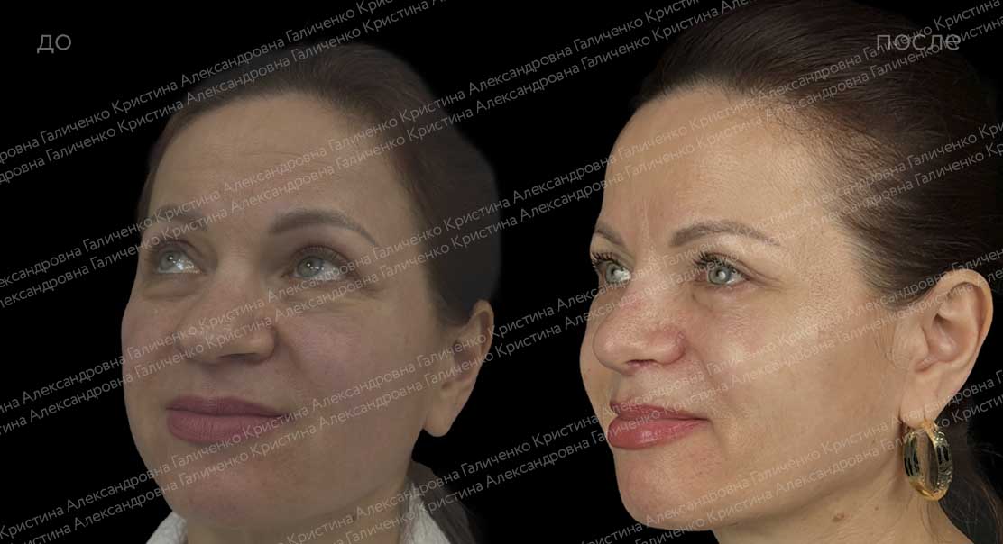 Нижняя блефаропластика с миопексией