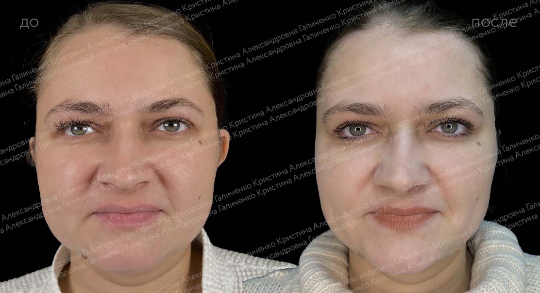 Пластика ушных раковин