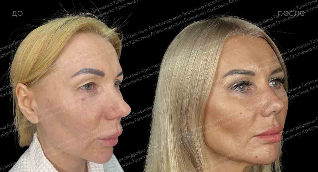Эндоскопический лобно-височный лифтинг + верхняя блефаропластика