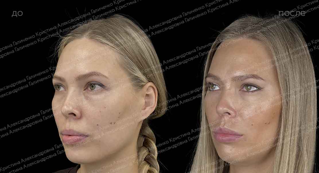 Трансконъюнктивальная нижняя блефаропластика
