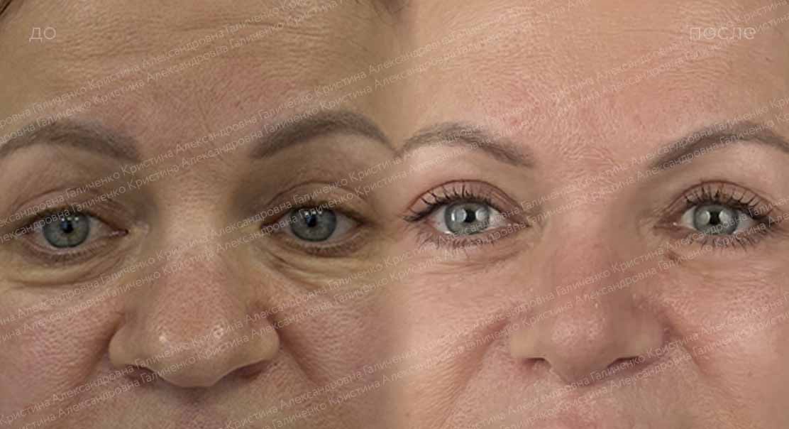 Нижняя блефаропластика и миопексия