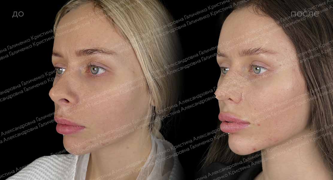 Подтяжка лба и виска + эффект "лисьего взгляда"