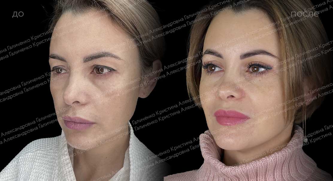 Верхняя блефаропластика