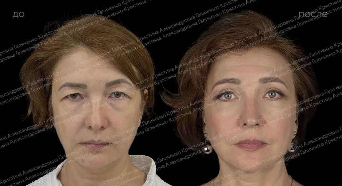 Круговая блефаропластика с миопексией