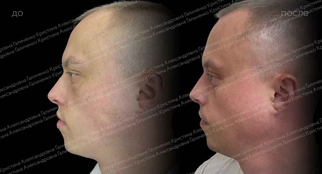 Нижняя трансконъюнктивальная блефаропластика