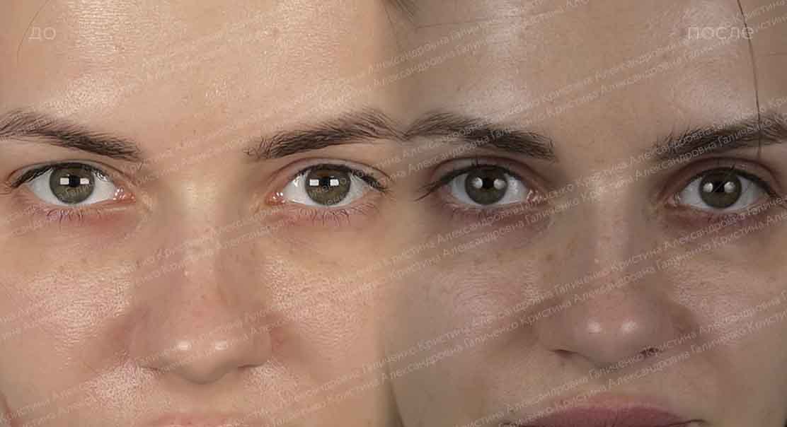 Верхняя блефаропластика + липосакция подбородка
