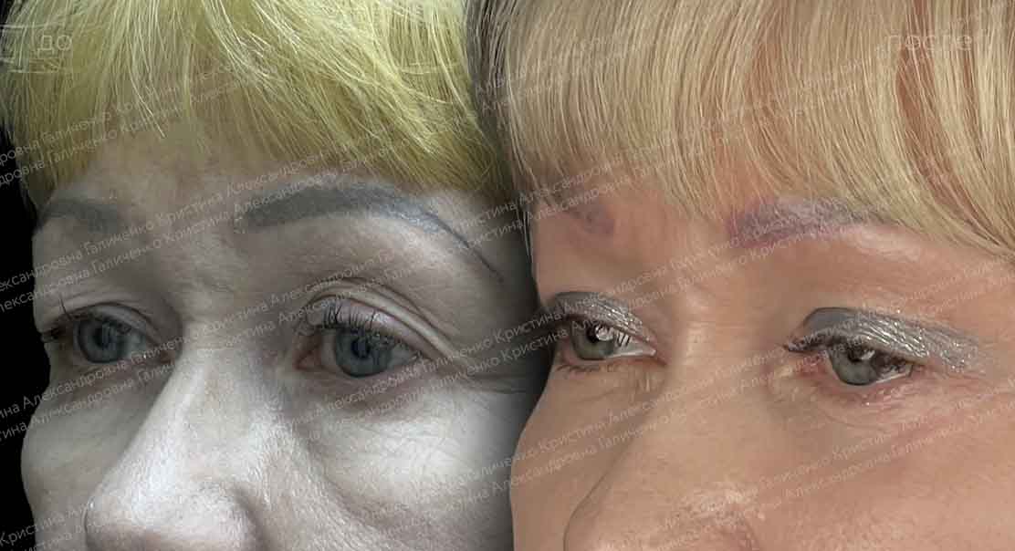 Комплексное омоложение лица