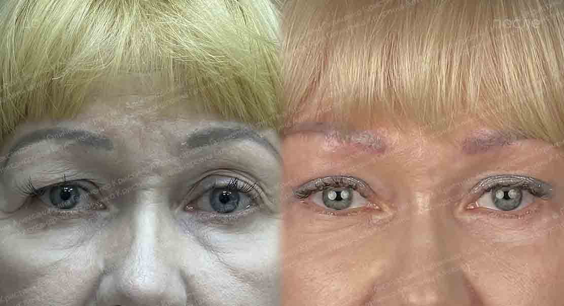 Комплексное омоложение лица