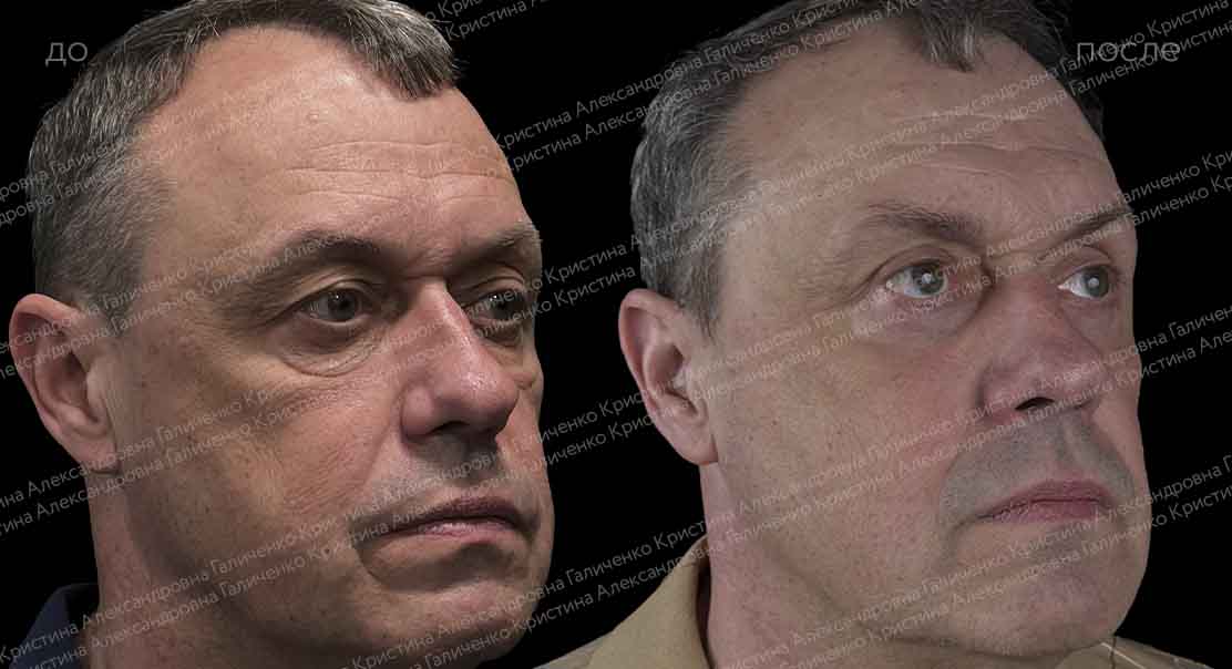Пластика верхних и нижних век