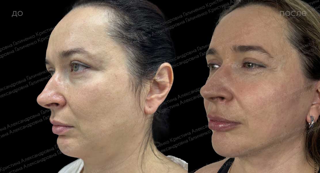 Лифтинг средней и нижней трети лица и шеи с коррекцией рубца на подбородке