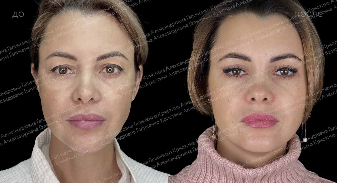 Верхняя блефаропластика