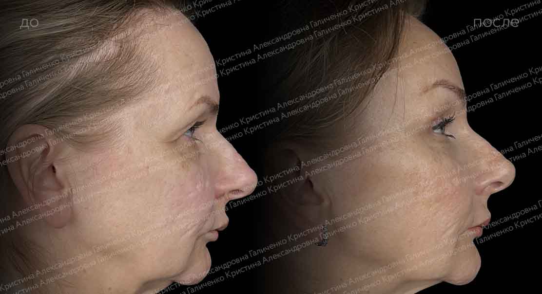 Верхняя блефаропластика + эндоскопический лобно-височный лифтинг