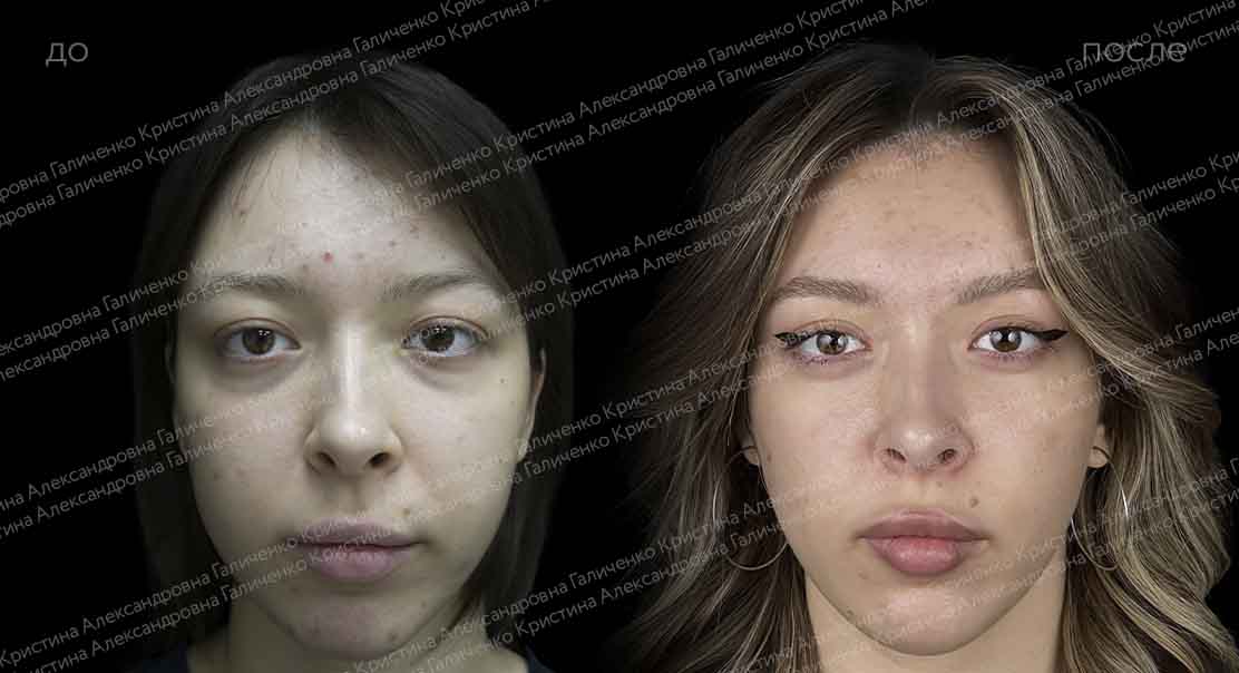 Круговая блефаропластика