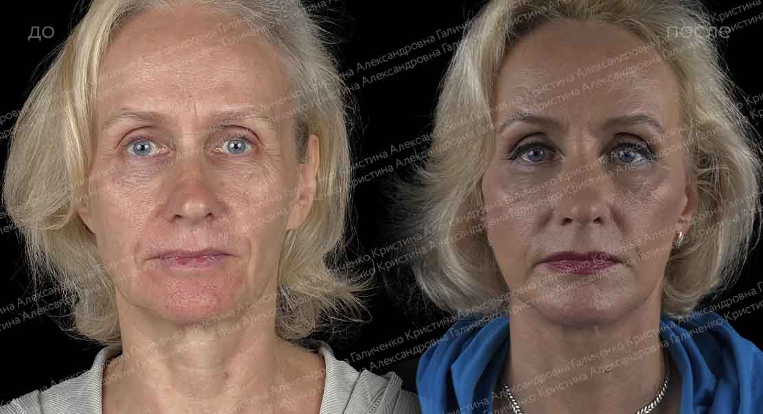 Комплексная пластика лица и шеи