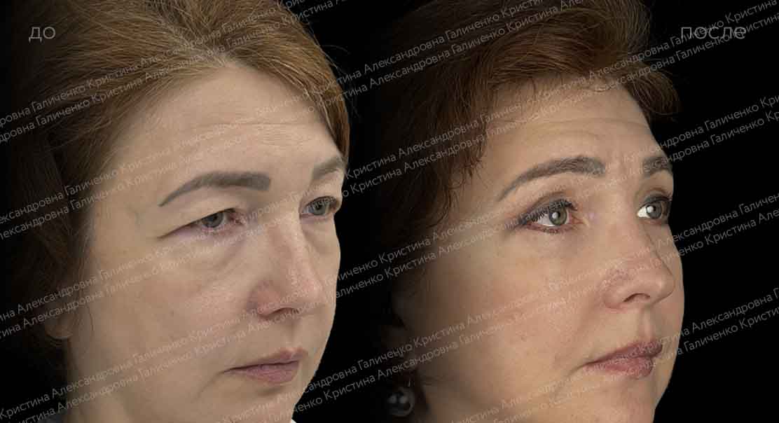 Круговая блефаропластика с миопексией