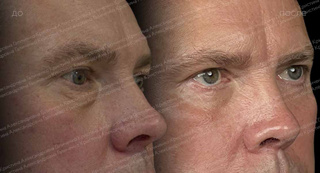 Нижняя блефаропластика + миопексия