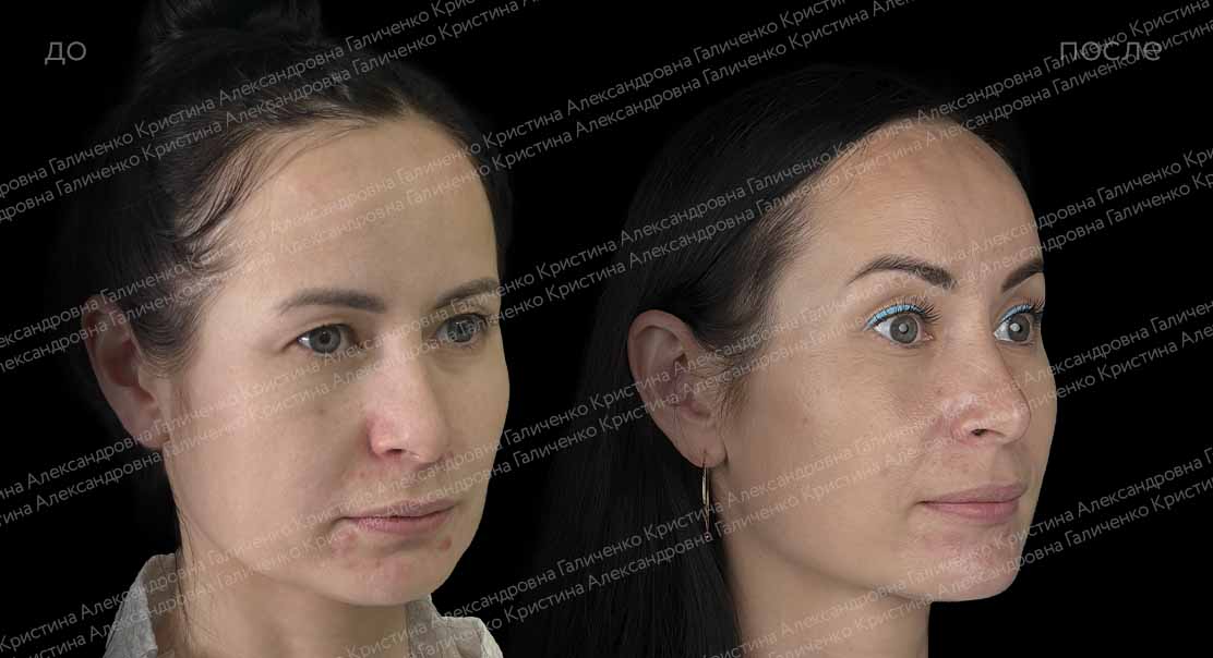 Эндоскопический лобно-височный лифтинг