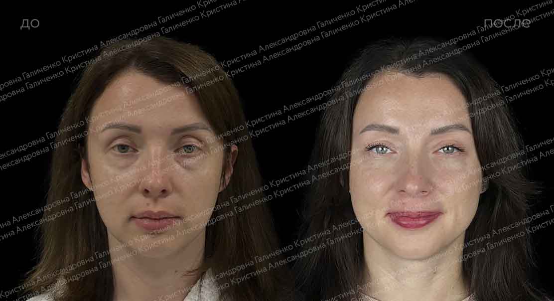 Пластика нижних век с миопексией