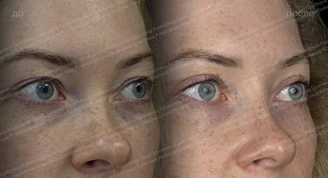 Классическая верхняя блефаропластика + трансконъюнктивальная пластика нижних век