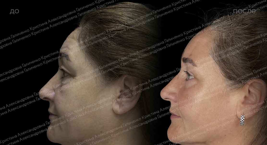 Пластика верхних и нижних век + миопексия