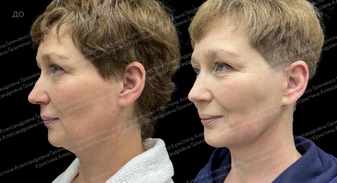 SMAS-лифтинг + медиальная платизмопластика