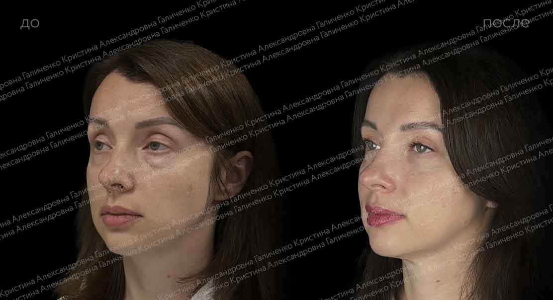 Пластика нижних век с миопексией