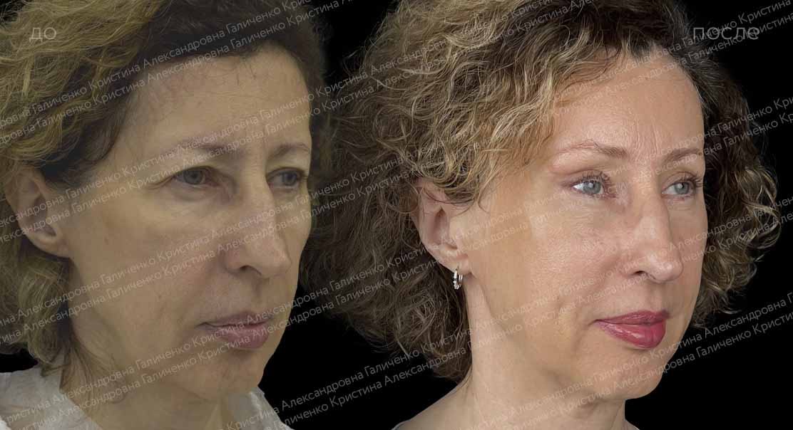 Верхняя блефаропластика + эндоскопический лобно-височный лифтинг