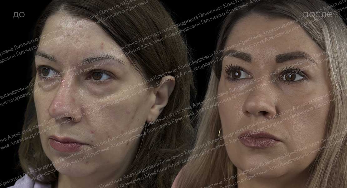 Нижняя блефаропластика