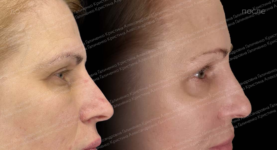 Нижняя блефаропластика + эндоскопический лобно-височный лифтинг