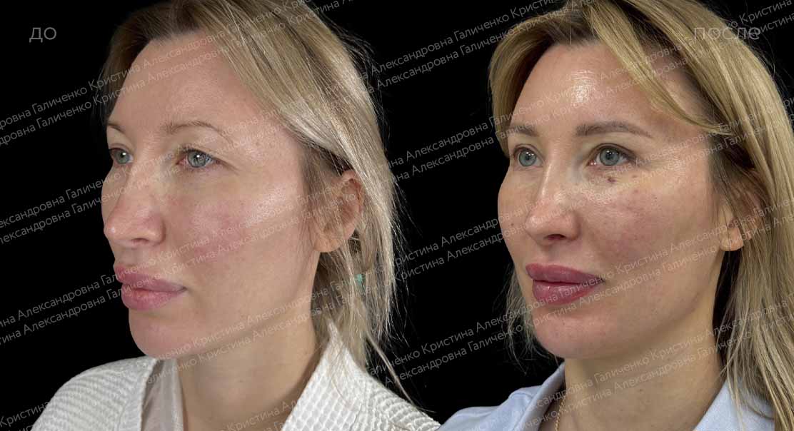Эндоскопический лобно-височный лифтинг + верхняя блефаропластика