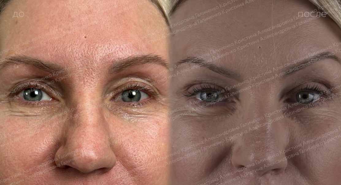 Комплексная пластика лица и шеи