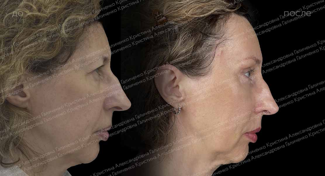 Верхняя блефаропластика + эндоскопический лобно-височный лифтинг