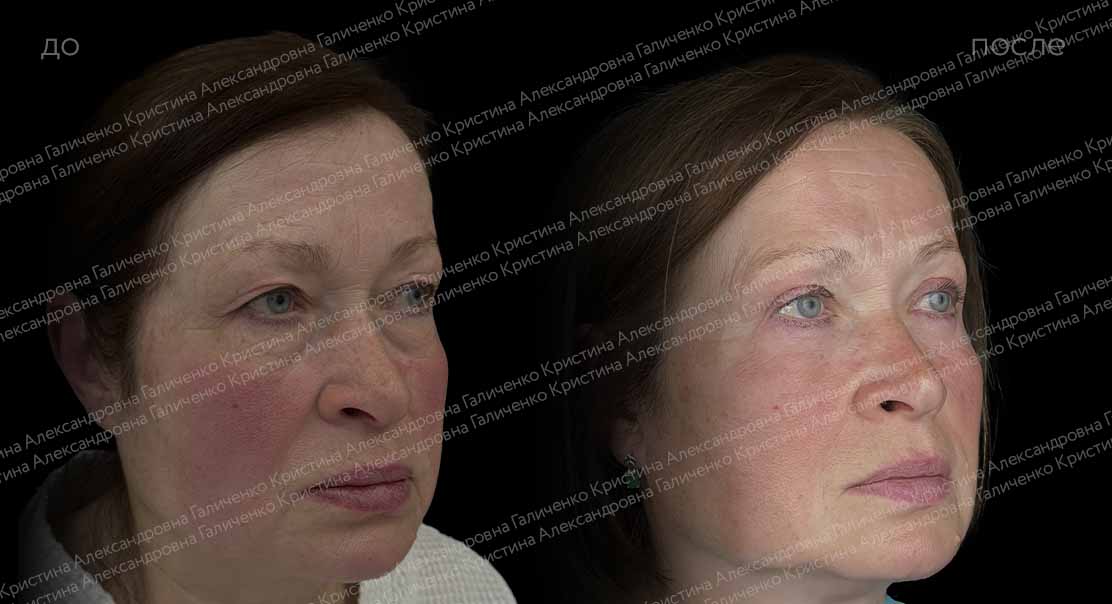 Круговая блефаропластика с миопексией