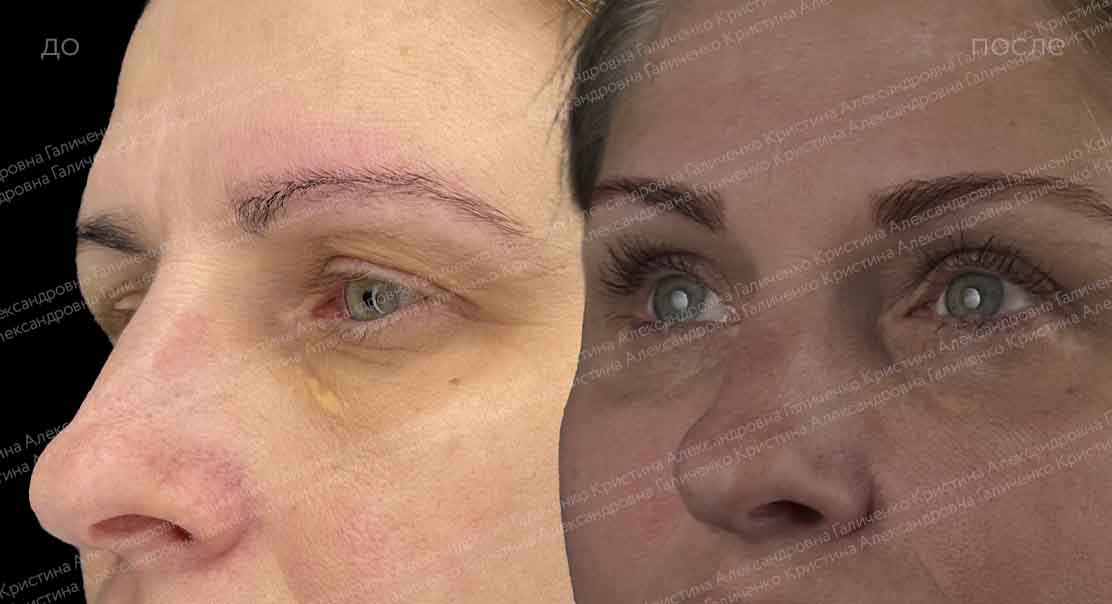 Нижняя блефаропластика + эндоскопичесий лобно-височный лифтинг