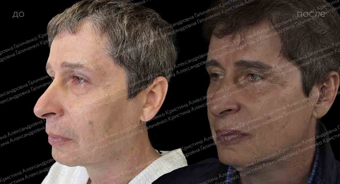 Нижняя блефаропластика