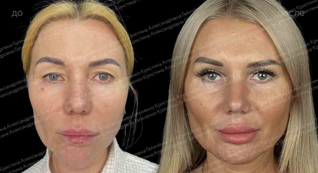 Эндоскопический лобно-височный лифтинг + верхняя блефаропластика