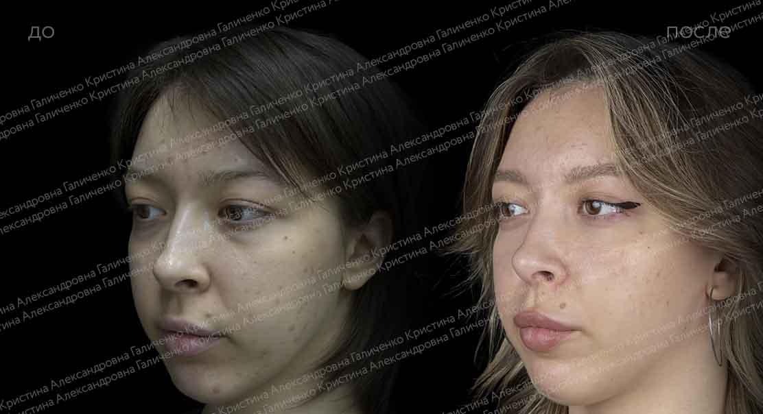 Круговая блефаропластика